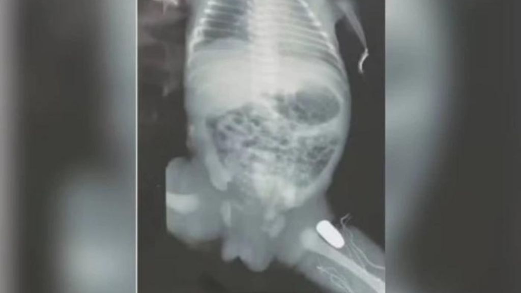 PROJÉTIL FICA ALOJADO EM PERNA DE BEBÊ AINDA NA BARRIGA DA MÃE EM IMPERATRIZ